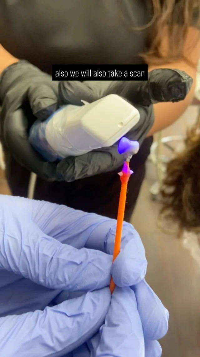 Shaping success before the final step! 

A well-contoured temporary restoration does more than fill the gap—it guides soft tissue adaptation for a seamless, long-lasting result:

✔️ Defines the emergence profile
✔️ Stabilizes gingival margins
✔️ Ensures better hygiene access
✔️ Promotes healthy healing
✔️ Helps refine esthetics & function

Rushing to the final crown without tissue conditioning? 

That’s a shortcut to unpredictable results. Precision takes time, and the tissue remembers!

.
.
.

#prosthodontisthatorey #dentistpuertorico #prosthodontistcondado #dentaltipscondado #mouthrehabilitation
