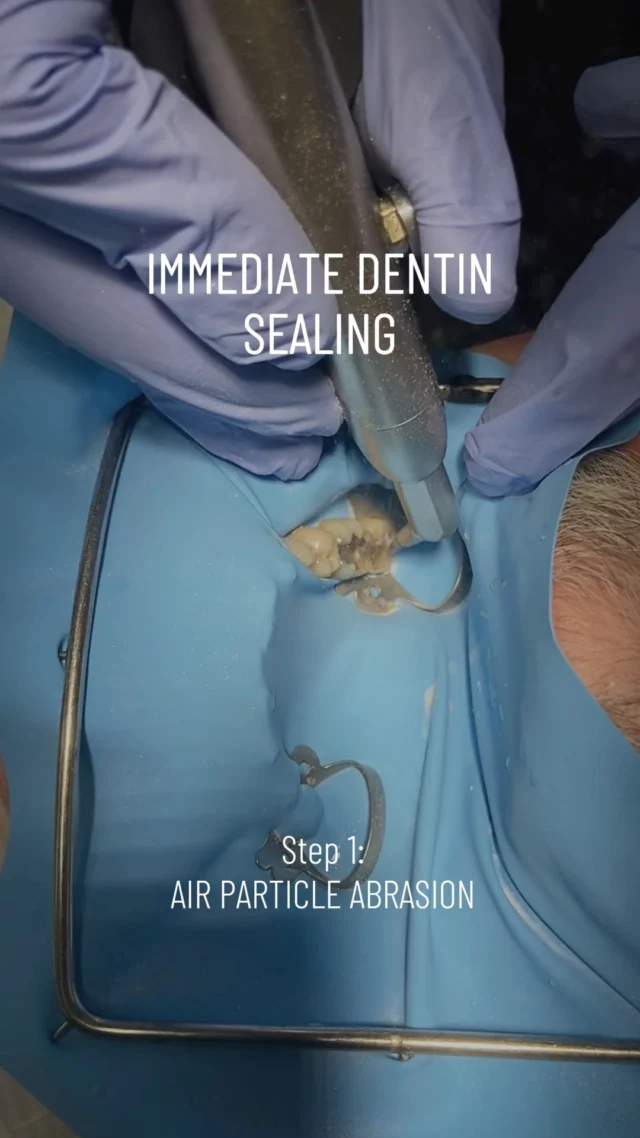 🔬 Immediate Dentin Sealing (IDS) after overlay prep — my way using All-Bond 3 by BISCO!

IDS is a game-changing technique in adhesive dentistry that helps reduce chances of debonding, sensitivity, and restoration failure by sealing dentin right after prep. ✅

- Better clinical outcomes
- More patient comfort
- Fewer complications

Want better results with indirect restorations? IDS is the move.

*Tip: Always read your adhesive system’s instructions! 👀🦷

.
.
.

#mouthrehabilitation #prosthodontisthatorey #prosthodontistpuertorico #prosthodontistcondado #dentaltipscondado