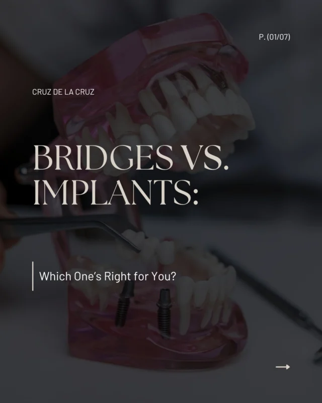 Missing a tooth and not sure what to do about it? 🦷

�Let’s break down the two most common solutions: dental bridges and implants—what they are, how they work, and which one might be best for you.

�Swipe through to get the facts! 

.
.
.

#prosthodontistcondado #prosthodontisthatorey #dentaltipscondado #puertoricoprosthodontist #prosthodontistpuertorico #dentistpuertorico
